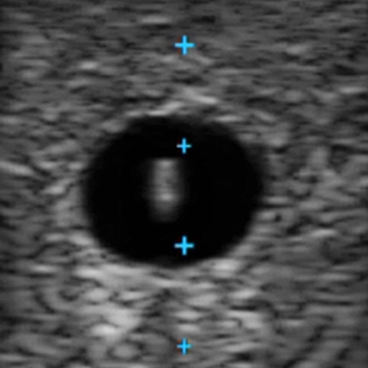 Vascular Access Ultrasound Phantom - 4 Vein Bifurcated with Deep Vein