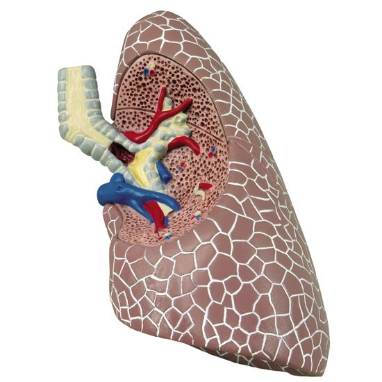 GPI Anatomicals Diseased Lung Anatomy Model | Anatomy Warehouse
