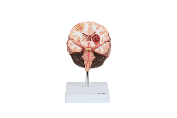 Axis Scientific Human Brain Anatomy Model with Pathologies Axis Scientific Human Brain Anatomy Model with Pathologies