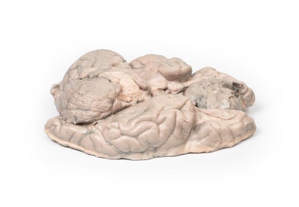 3D Printed Meningioma 3D Printed Meningioma
