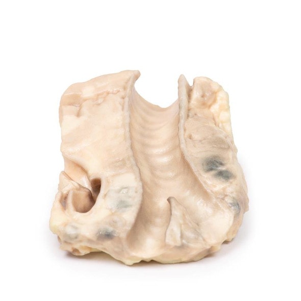 3D Printed Hodgkin Lymphoma in the Trachea 3D Printed Hodgkin Lymphoma in the Trachea