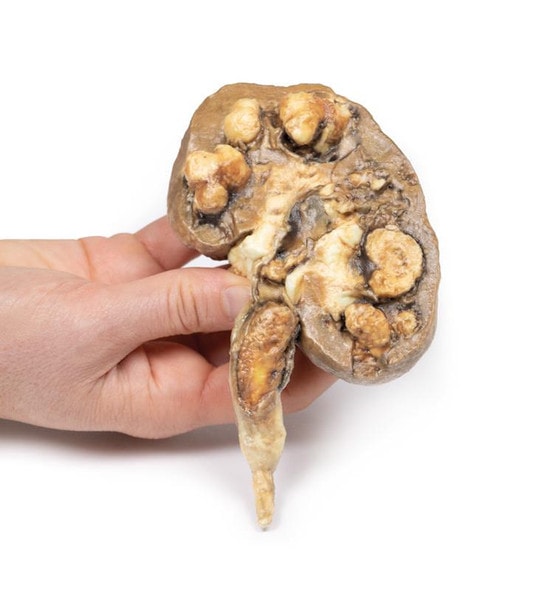 3D Printed Multiple Renal Calculi 3D Printed Multiple Renal Calculi