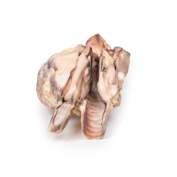 3D Printed Lymphoma of the Thyroid 3D Printed Lymphoma of the Thyroid