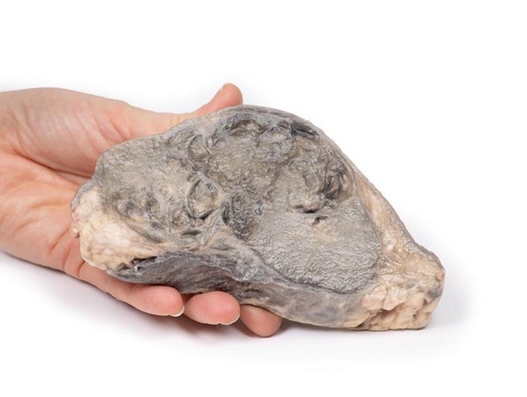 3D Printed Carcinoma of Breast 3D Printed Carcinoma of Breast
