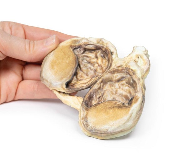 3D Printed Chronic Hydrocoele 3D Printed Chronic Hydrocoele
