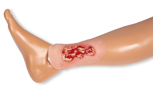 Wound Moulage Venous Leg Ulcer, Small, Exudation Phase Wound Moulage Venous Leg Ulcer, Small, Exudation Phase