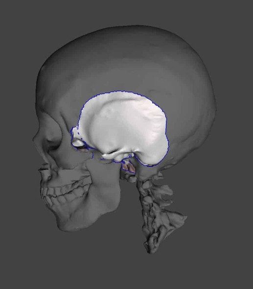 Temporal Bone Phantoms for X-Ray CT, Ultrasound, MRI