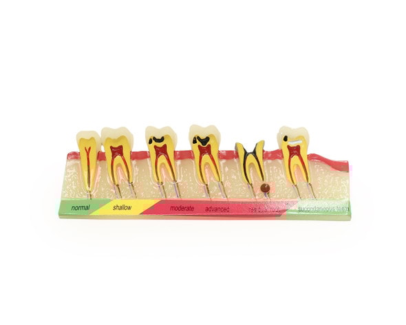 Axis Scientific Stages of Tooth Decay Anatomy Model