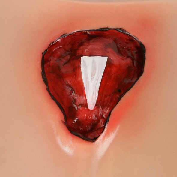 Anatomy Lab Bedsore Cleansing and Dressing Model Anatomy Lab Bedsore Cleansing and Dressing Model
