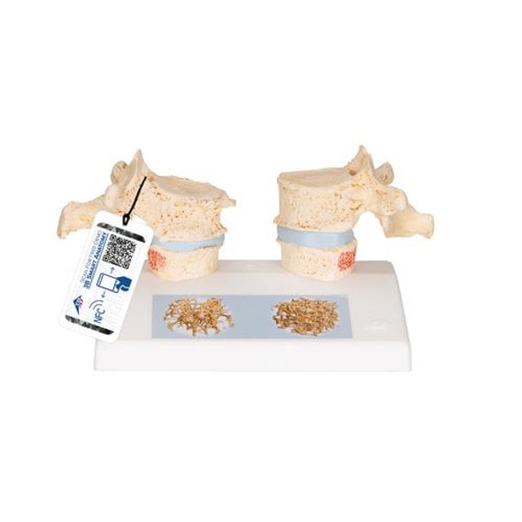 Osteoporosis Anatomy Model Osteoporosis Anatomy Model