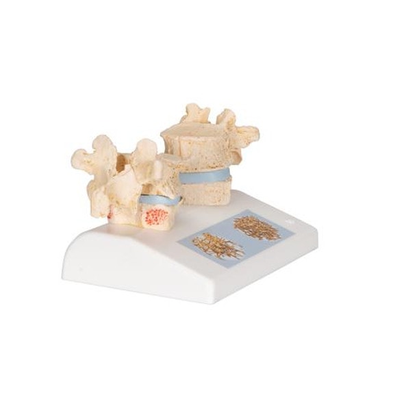 Osteoporosis Anatomy Model Osteoporosis Anatomy Model