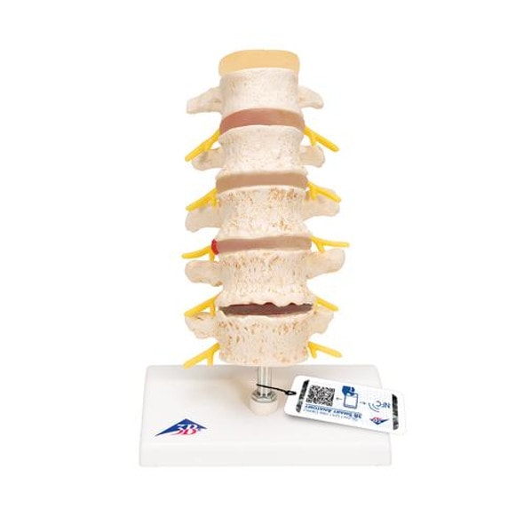 Stages Of Disc Prolapse and Vertebral Degeneration Anatomy Model Stages Of Disc Prolapse and Vertebral Degeneration Anatomy Model