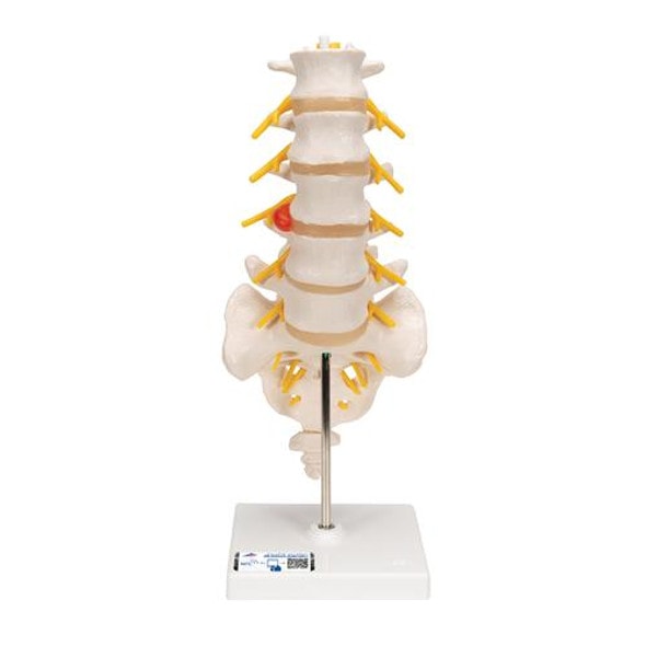 Lumbar Spinal Column Anatomy Model With Dorso-Lateral Prolapsed Intervertebral Disc Lumbar Spinal Column Anatomy Model With Dorso-Lateral Prolapsed Intervertebral Disc