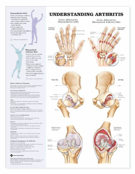 Understanding Arthritis Laminated Anatomical Chart Understanding Arthritis Laminated Anatomical Chart