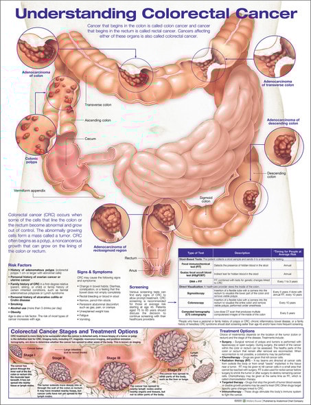 Understanding Colorectal Cancer Laminated Anatomical Chart, 2nd Edition Understanding Colorectal Cancer Laminated Anatomical Chart, 2nd Edition