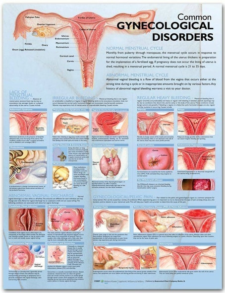 Common Gynecological Disorders Laminated Anatomical Chart Common Gynecological Disorders Laminated Anatomical Chart