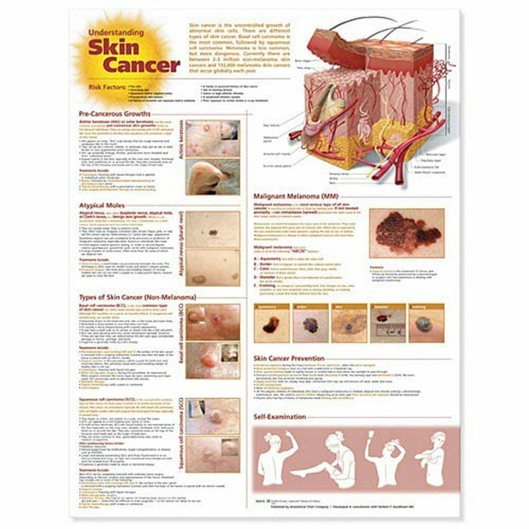 Understanding Skin Cancer Laminated Anatomical Chart, 3rd Edition Understanding Skin Cancer Laminated Anatomical Chart, 3rd Edition