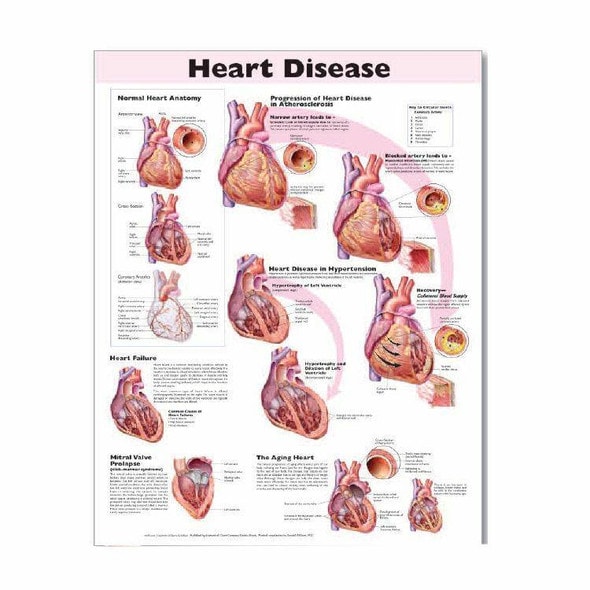 Anatomie-Poster COPD – Chronisch Obstruktive Lungenerkrankung Erklärt Mit Illustrationen & Infos