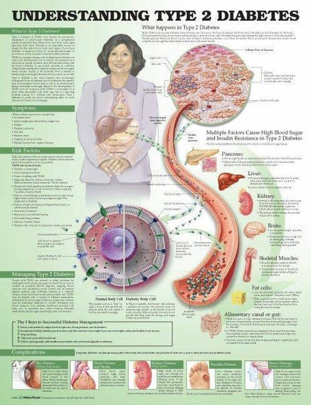 Understanding Type 2 Diabetes Laminated Anatomical Chart 3rd Edition Understanding Type 2 Diabetes Laminated Anatomical Chart 3rd Edition