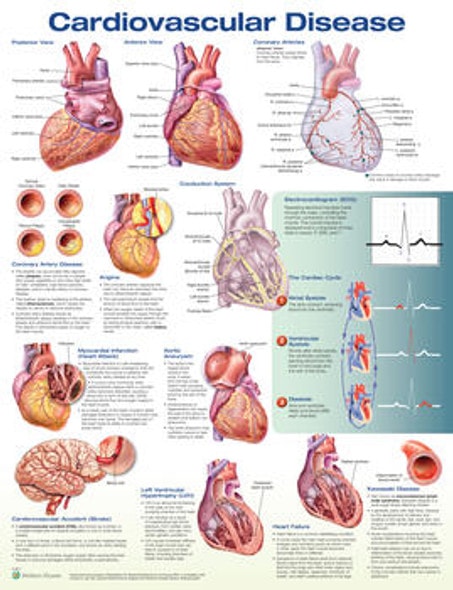 Cardiovascular Disease Laminated Anatomical Chart - 3rd Edition Cardiovascular Disease Laminated Anatomical Chart - 3rd Edition