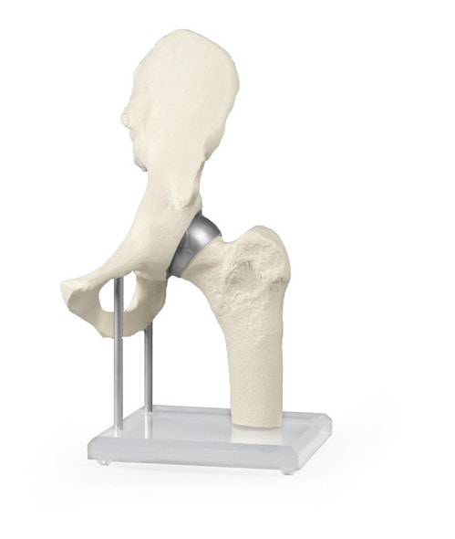 Hip Joint with Resurfacing Implant Hip Joint with Resurfacing Implant