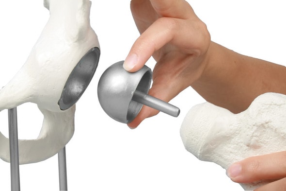 Hip Joint with Resurfacing Implant Hip Joint with Resurfacing Implant