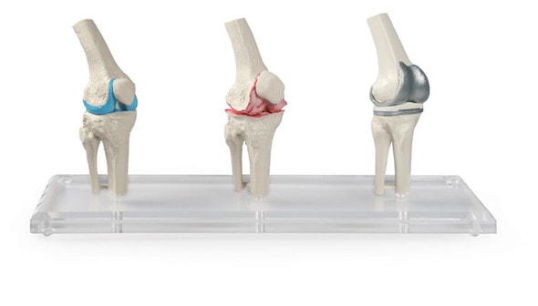 Knee Implant Model