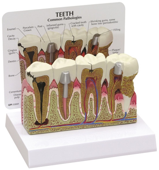 Diseased Teeth and Gums Anatomy Model