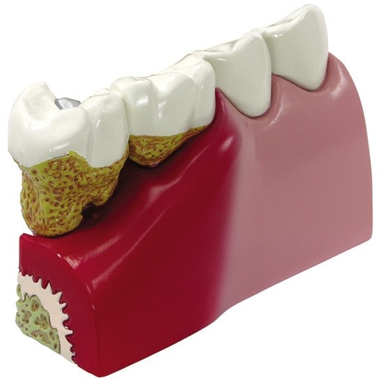 Diseased Teeth and Gums Anatomy Model
