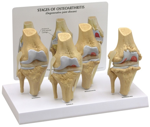 4 Stage Osteoarthritis Knee Set Anatomy Model