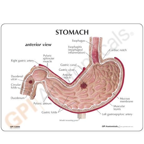 Stomach With Ulcers Anatomy Model