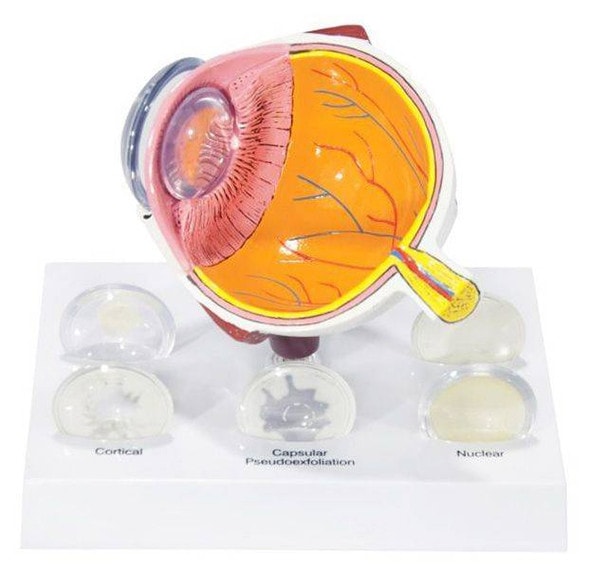 Cataract Eye Anatomy Model Cataract Eye Anatomy Model