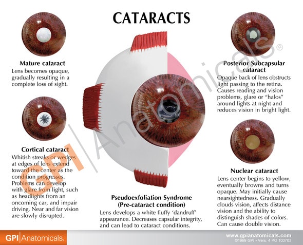 Cataract Eye Anatomy Model