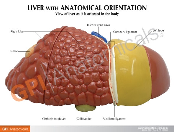 Diseased Liver Anatomy Model