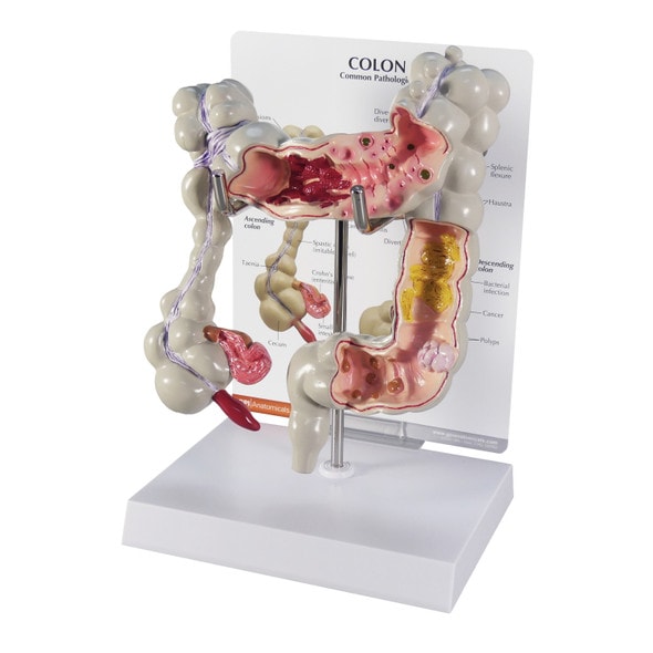 Colon Anatomy Model With Pathologies