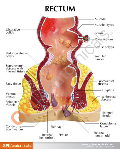 Rectum Anatomy Model With Pathologies