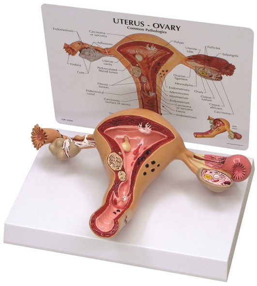 Uterus and Ovary Anatomy Model With Pathologies Uterus and Ovary Anatomy Model With Pathologies