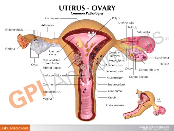 Uterus and Ovary Anatomy Model With Pathologies