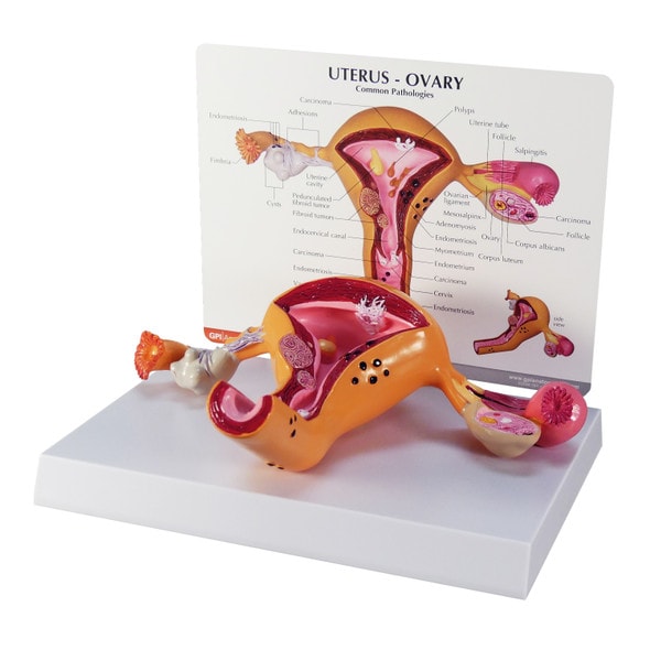 Uterus and Ovary Anatomy Model With Pathologies