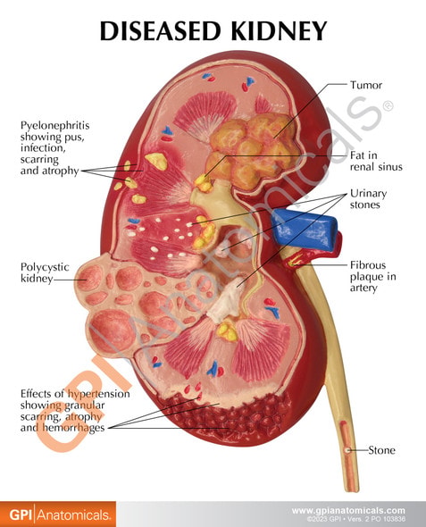 Diseased Kidney Anatomy Model