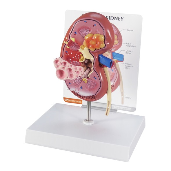 Diseased Kidney Anatomy Model