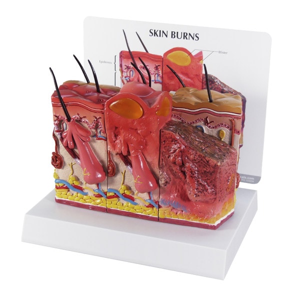 Skin Burn and Normal Skin Anatomy Model