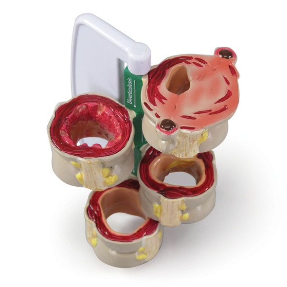 4-Piece Colon With Pathologies Anatomy Model
