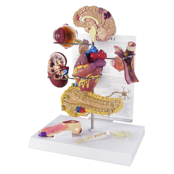 Type 2 Diabetes Anatomy Model
