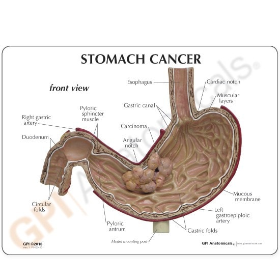 Stomach Cancer Anatomy Model