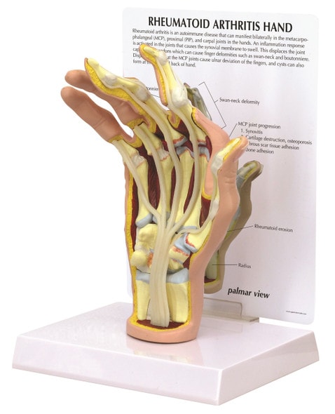 Rheumatoid Arthritis Hand Anatomy Model
