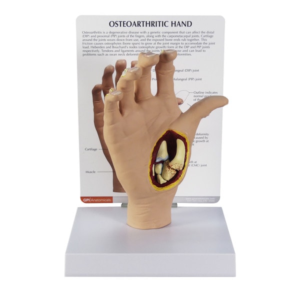 Osteoarthritis Hand Anatomy Model