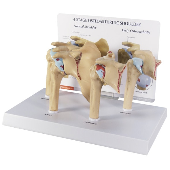 4-Stage Osteoarthritis Shoulder Anatomy Model