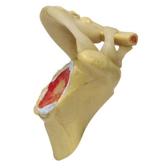 4-Stage Osteoarthritis Shoulder Anatomy Model
