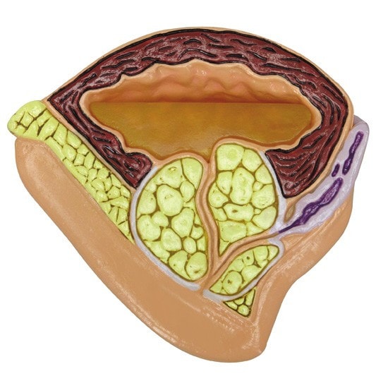 Male Pelvis with Benign Prostatic Hyperplasia Insert